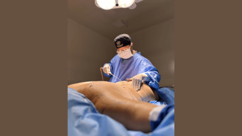 Tecnologias de retração cutânea na lipoaspiração: Entenda com Milton Seigi Hayashi